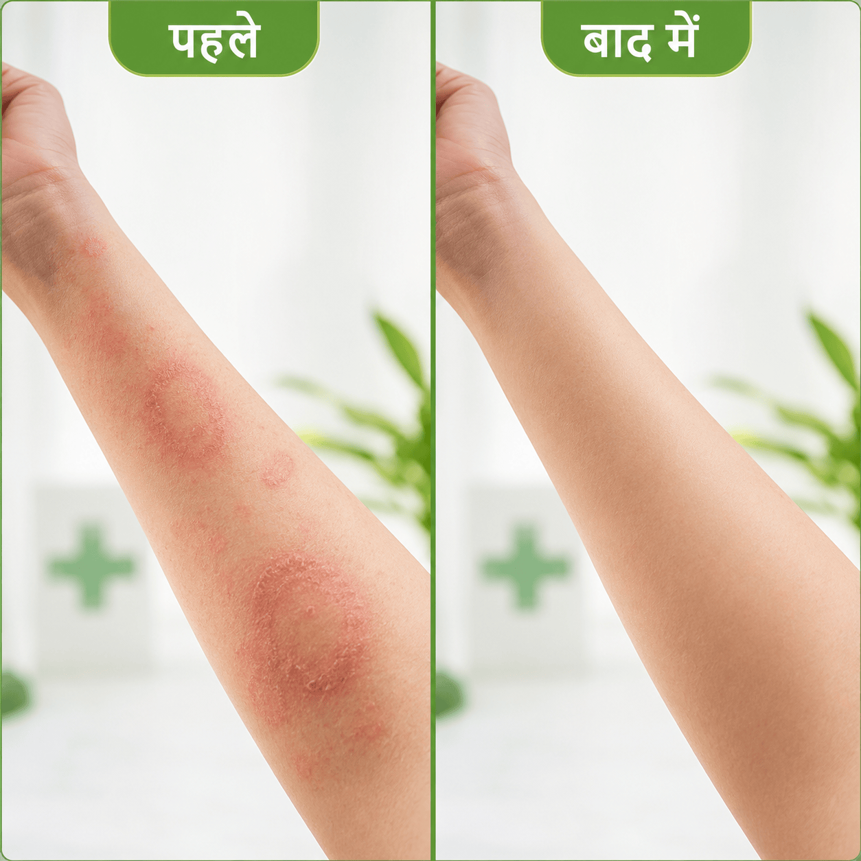 Doctor Alleryo BC20 Before After Result — Eczema, Daad, Khujli से Clear Healthy Skin — Teqtis India