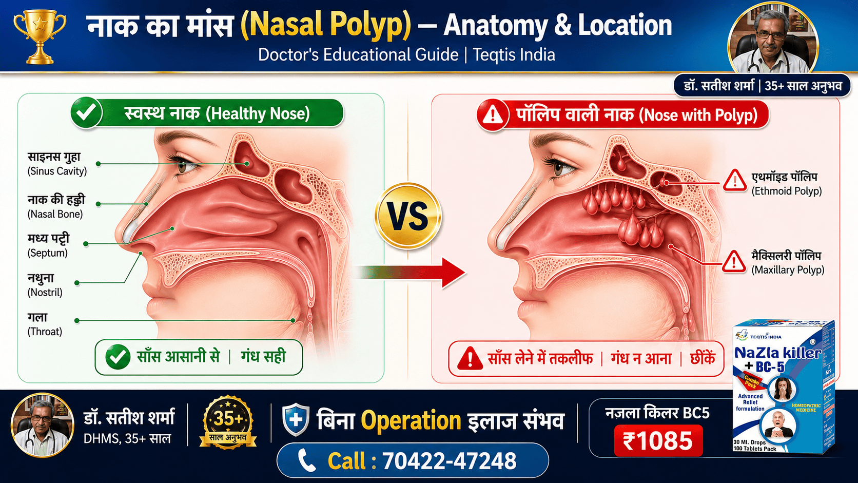 नज़ला साइनस नेज़ल पॉलिप एनाटॉमी डायग्राम हिंदी - नाक व साइनस की बनावट doctor guide - Teqtis India Nazla Killer BC5