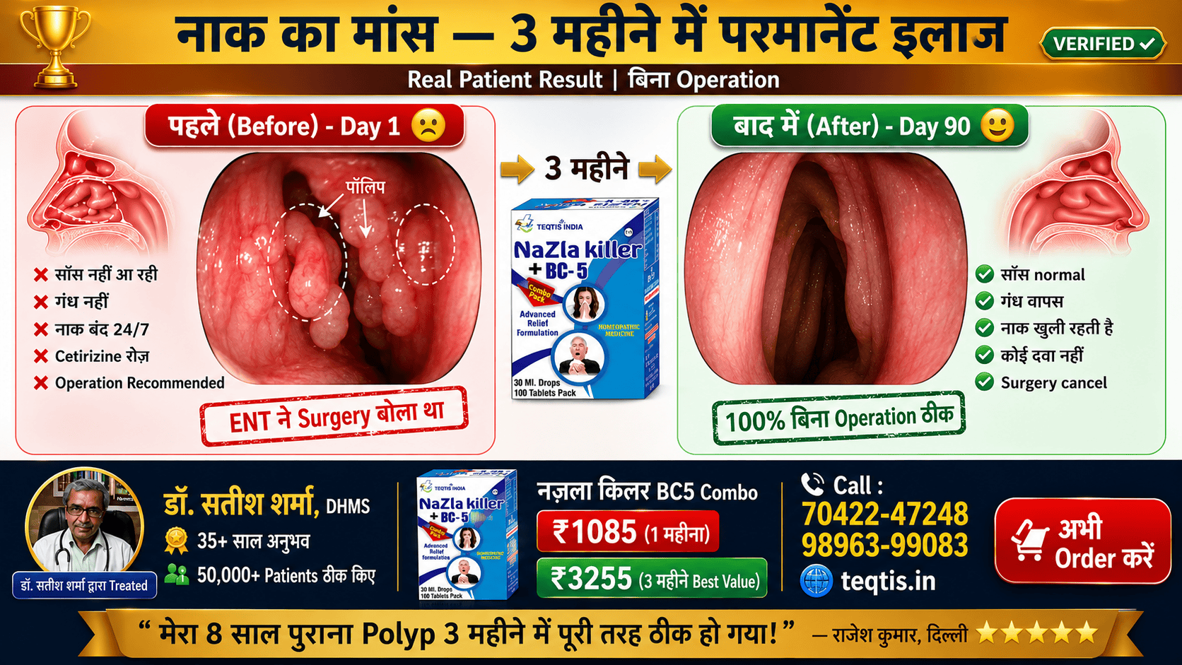 🏆 Real Result - 3 महीने में परमानेंट इलाज - बिना Operation नाक का मांस Before After 3 महीने - Nasal Polyp Permanent Cure Without Surgery by Dr. Satish Sharma